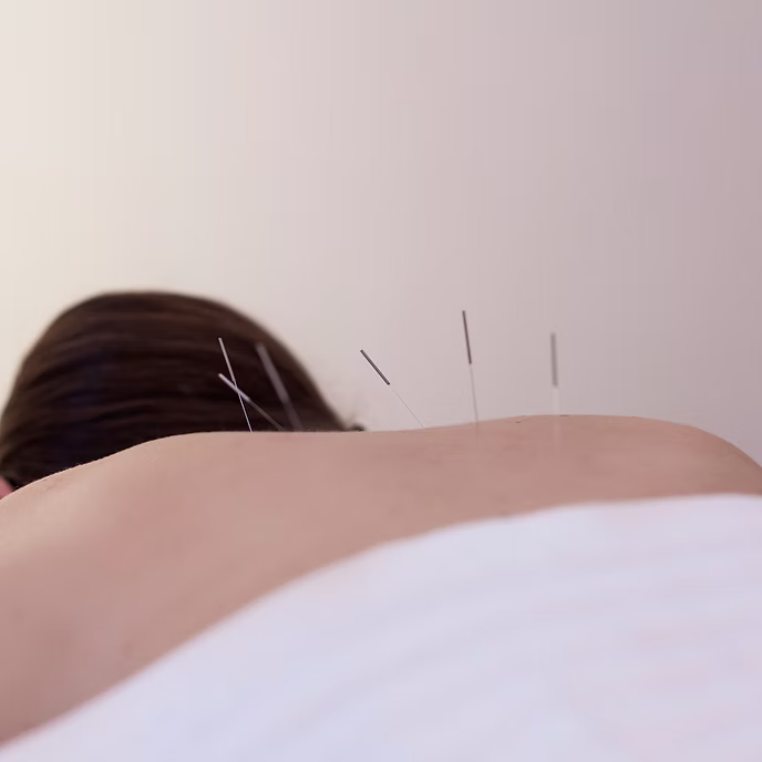 Akupunktur Behandlung